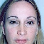 Eyelid Surgery Browlift Before & After Patient #1826