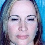 Eyelid Surgery Browlift Before & After Patient #1826