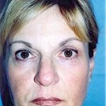 Eyelid Surgery Browlift Before & After Patient #1825
