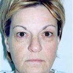 Eyelid Surgery Browlift Before & After Patient #1825