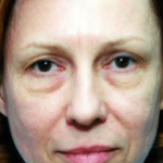 Eyelid Surgery Browlift Before & After Patient #1824