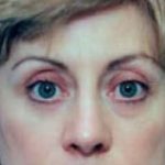 Eyelid Surgery Browlift Before & After Patient #1823