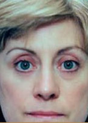 Eyelid Surgery Browlift Before & After Patient #1823