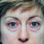 Eyelid Surgery Browlift Before & After Patient #1823