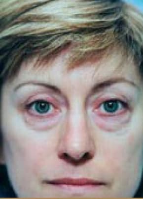 Eyelid Surgery Browlift Before & After Patient #1823