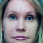 Eyelid Surgery Browlift Before & After Patient #1822