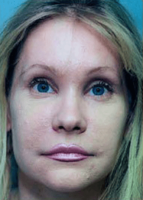 Eyelid Surgery Browlift Before & After Patient #1822
