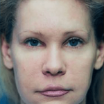 Eyelid Surgery Browlift Before & After Patient #1822