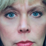 Eyelid Surgery Browlift Before & After Patient #1821