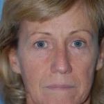Eyelid Surgery Browlift Before & After Patient #1820