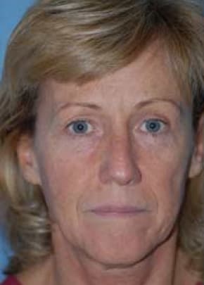 Eyelid Surgery Browlift Before & After Patient #1820