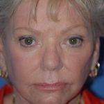 Eyelid Surgery Browlift Before & After Patient #1819