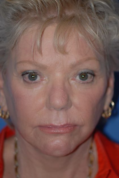 Eyelid Surgery Browlift Before & After Patient #1819