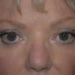 Eyelid Surgery Browlift Before & After Patient #1819