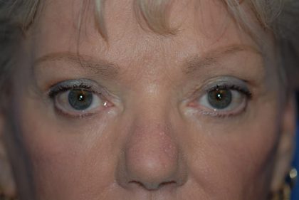 Eyelid Surgery Browlift Before & After Patient #1819