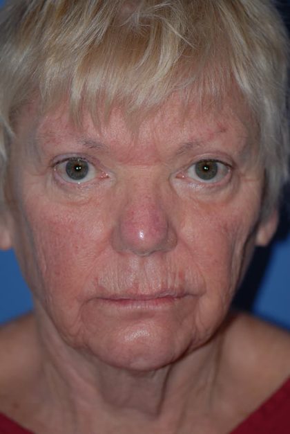 Eyelid Surgery Browlift Before & After Patient #1819