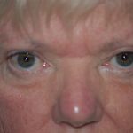 Eyelid Surgery Browlift Before & After Patient #1819
