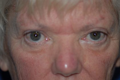 Eyelid Surgery Browlift Before & After Patient #1819