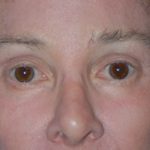 Eyelid Surgery Browlift Before & After Patient #1762