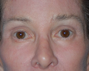 Eyelid Surgery Browlift Before & After Patient #1762