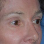 Eyelid Surgery Browlift Before & After Patient #1762