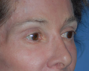 Eyelid Surgery Browlift Before & After Patient #1762