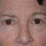 Eyelid Surgery Browlift Before & After Patient #1762