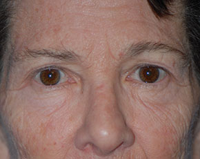 Eyelid Surgery Browlift Before & After Patient #1762