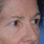 Eyelid Surgery Browlift Before & After Patient #1762
