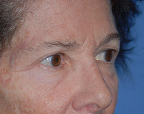 Eyelid Surgery Browlift Before & After Patient #1762