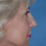 Facelift and Necklift Before & After Patient #1759