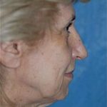 Facelift and Necklift Before & After Patient #1759