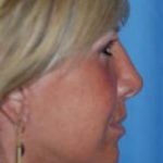 Facelift and Necklift Before & After Patient #1758