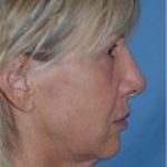 Facelift and Necklift Before & After Patient #1758