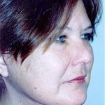 Facelift and Necklift Before & After Patient #1757
