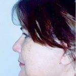 Facelift and Necklift Before & After Patient #1757