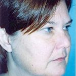 Facelift and Necklift Before & After Patient #1757