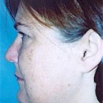 Facelift and Necklift Before & After Patient #1757