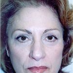 Facelift and Necklift Before & After Patient #1756