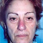 Facelift and Necklift Before & After Patient #1756