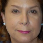 Facelift and Necklift Before & After Patient #1755