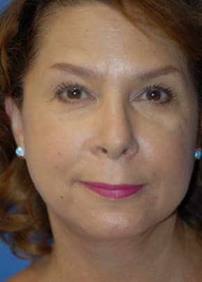 Facelift and Necklift Before & After Patient #1755