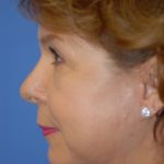 Facelift and Necklift Before & After Patient #1755