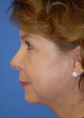 Facelift and Necklift Before & After Patient #1755