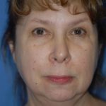 Facelift and Necklift Before & After Patient #1755