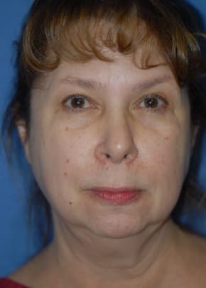 Facelift and Necklift Before & After Patient #1755