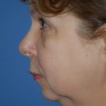 Facelift and Necklift Before & After Patient #1755