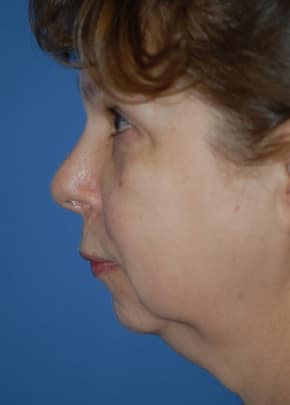 Facelift and Necklift Before & After Patient #1755
