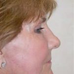 Facelift and Necklift Before & After Patient #1754