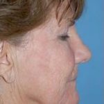 Facelift and Necklift Before & After Patient #1754